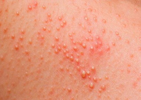 When the body is affected by parasites, a skin allergy appears