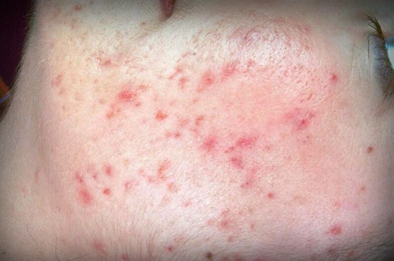 Redness of the skin with demodicosis